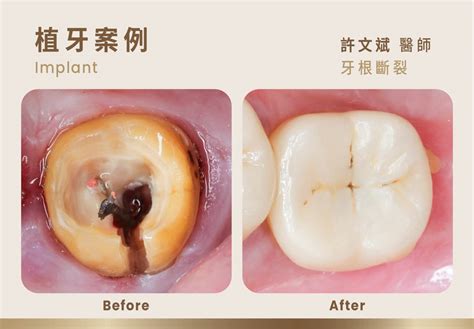 拔掉的牙齒|哪些情況需要 拔牙 ？拔牙後吃什麼？拔牙注意事項全。